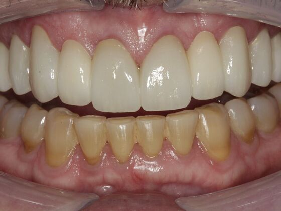 Full Mouth Rehabilitation Mike - After
