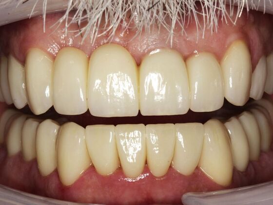 Full Mouth Rehabilitation Philip - After
