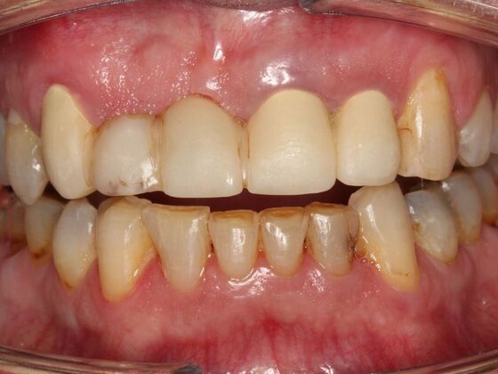 Full Mouth Rehabilitation Philip - Before