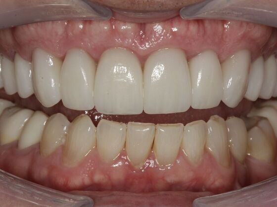 Full Mouth Rehabilitation Reed - Before