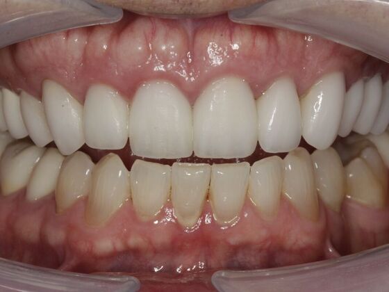 Full Mouth Rehabilitation Reed - After