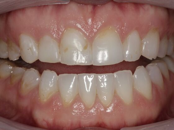 Full Mouth Rehabilitation Shannon  - Before