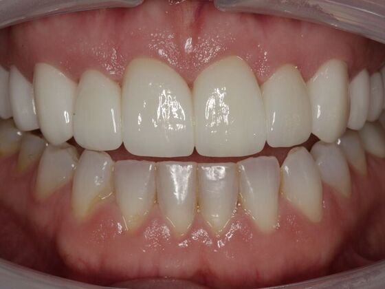 Full Mouth Rehabilitation Shannon  - After