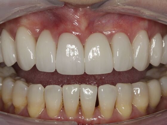 Full Mouth Rehabilitation Susan - After