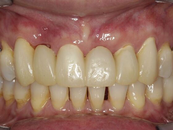 Full Mouth Rehabilitation Susan - Before