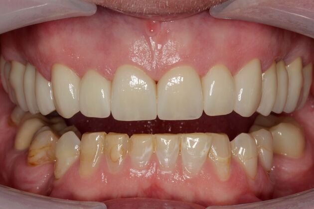 Full Mouth Rehabilitation Tom - After
