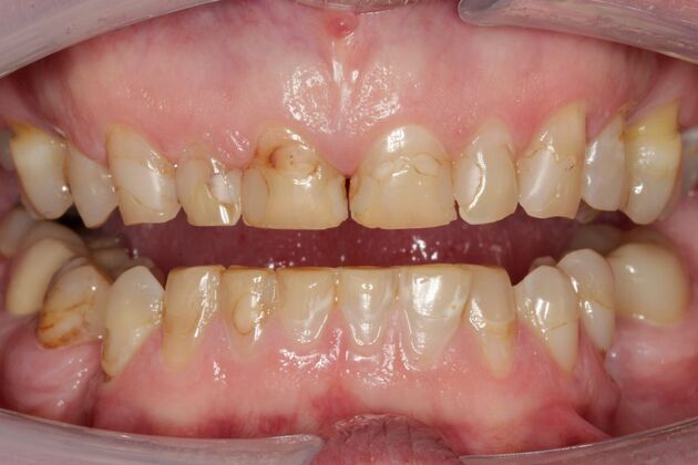 Full Mouth Rehabilitation Tom - Before