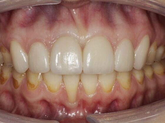 Veneers Annabelle  - After