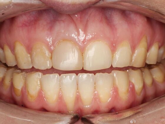 Veneers Annabelle  - Before