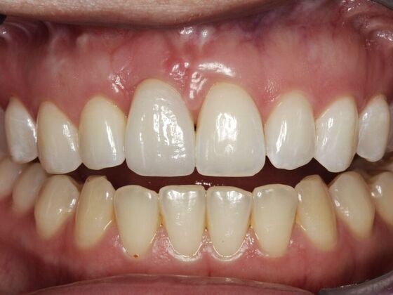 Veneers Deserae - After