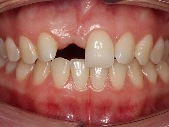 Veneers Deserae - Before
