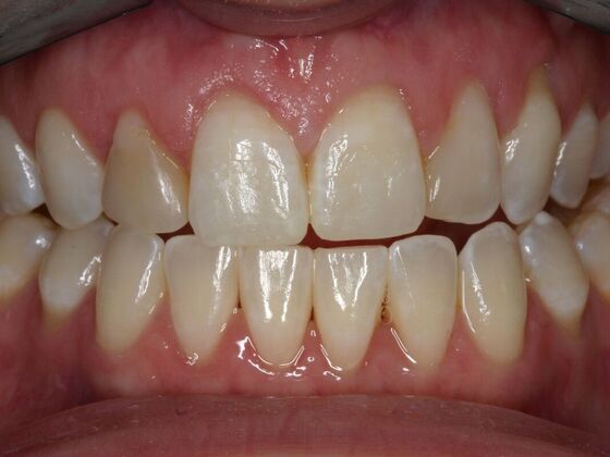 Veneers Jennifer - Before