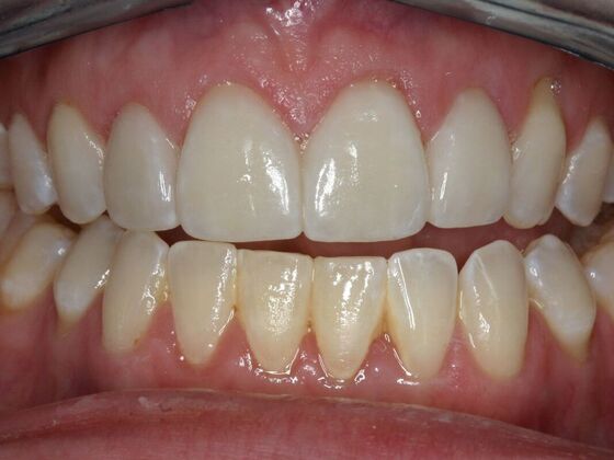 Veneers Jennifer - After