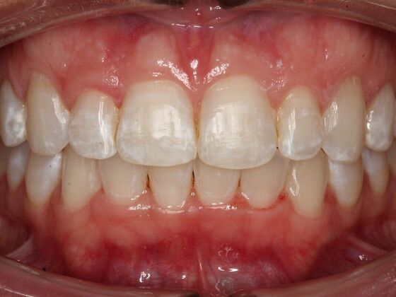 Veneers Jennifer Mitchell  - Before