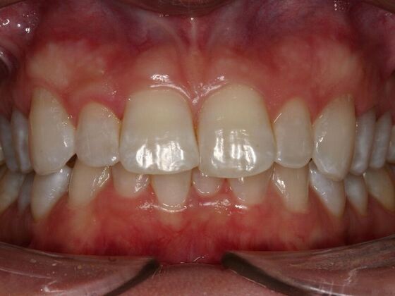 Veneers Jennifer Mitchell  - After