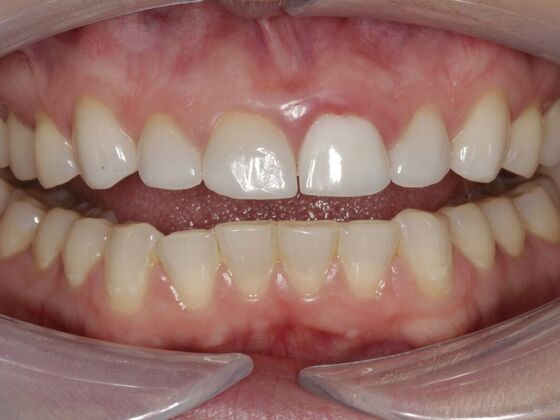 Veneers Kalin  - Before