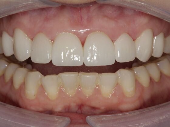 Veneers Kalin  - After