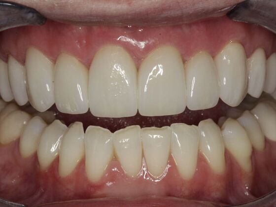 Veneers Kat  - After