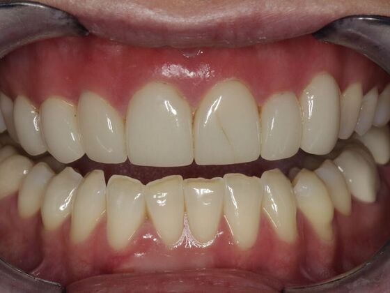Veneers Kat  - Before
