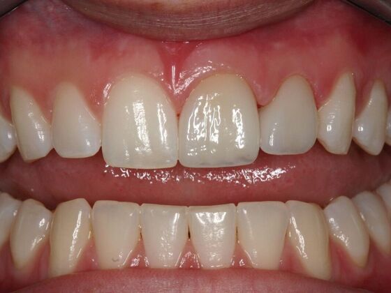 Veneers Madison D - After