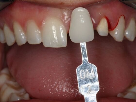 Veneers Madison D - Before