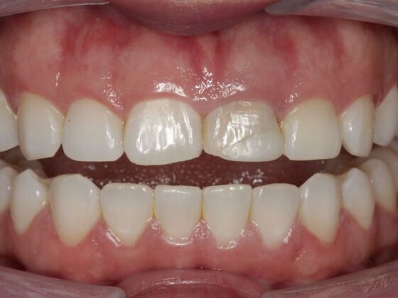 Veneers Maricruz L - Before