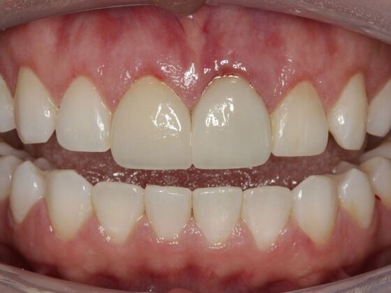 Veneers Maricruz L - After