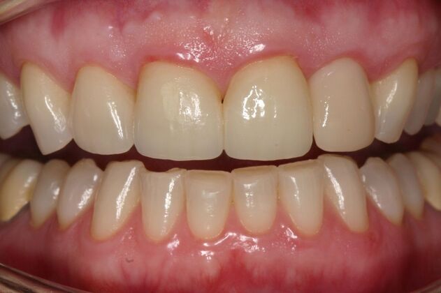 Veneers Mary A - After