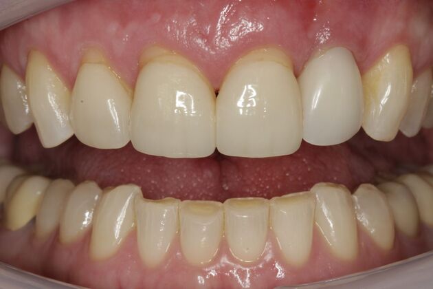 Veneers Mary A - Before