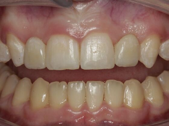 Implant Restorations Anne - After