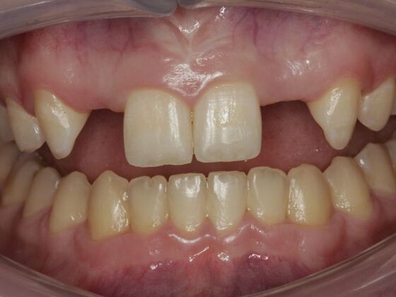 Implant Restorations Anne - Before