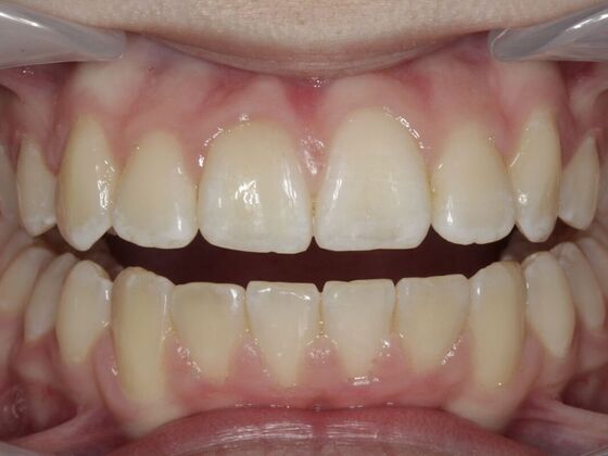 Orthodontics Audrina  - After