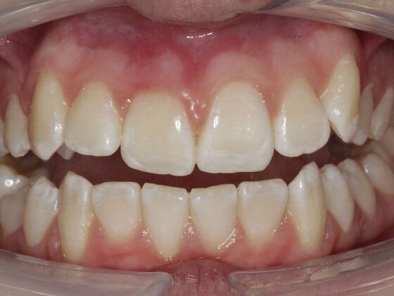 Orthodontics Audrina  - Before