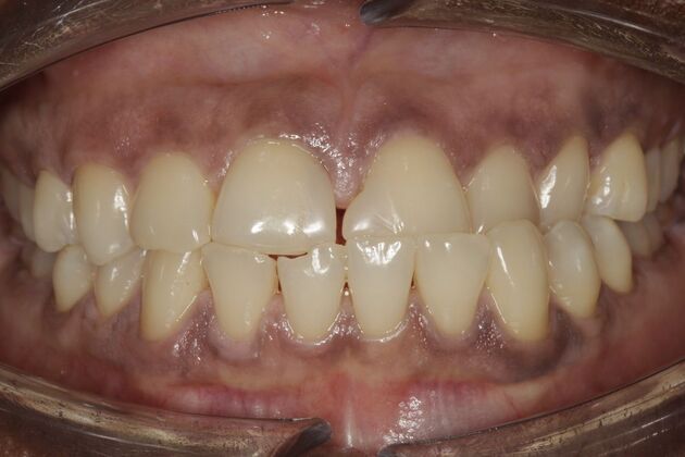 Orthodontics Gifty - Before