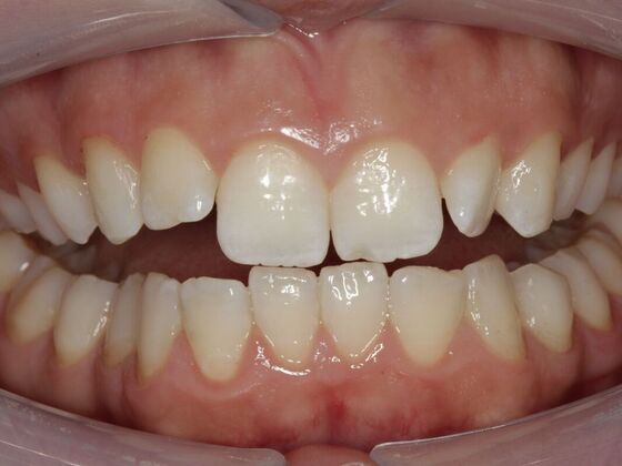 Orthodontics Michelle  - Before