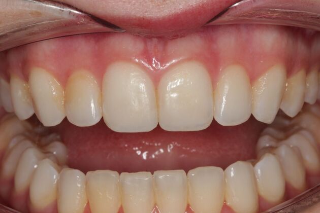 Cosmetic Bonding Charlotte - After