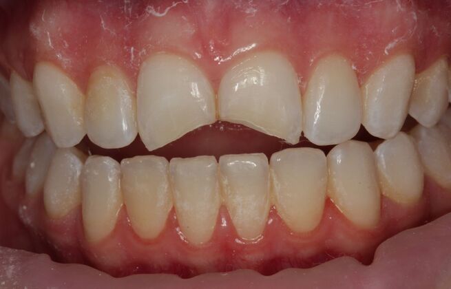 Cosmetic Bonding Charlotte - Before