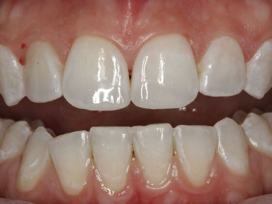 Cosmetic Bonding Liza - After
