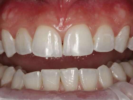 Cosmetic Bonding Liza - Before