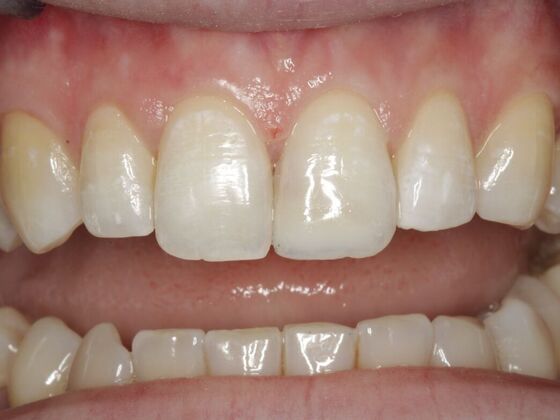 Cosmetic Bonding Merisa  - After