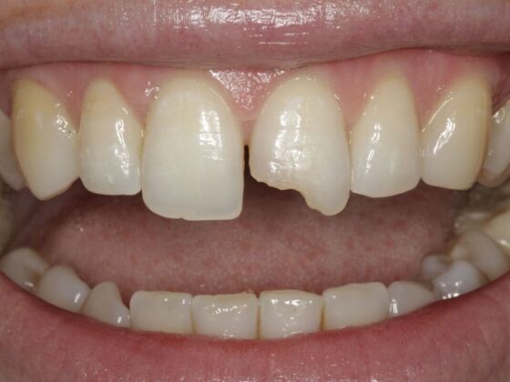 Cosmetic Bonding Merisa  - Before