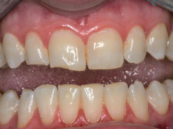 Cosmetic Bonding Nicole - Before