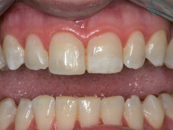 Cosmetic Bonding Nicole - After