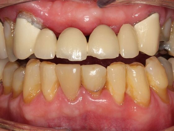 Implant Retained Overdentures Dennis - Before