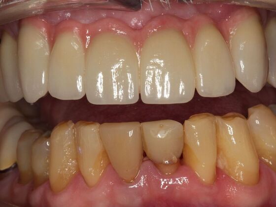Implant Retained Overdentures Dennis - After