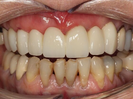 Implant Retained Overdentures Janis - After