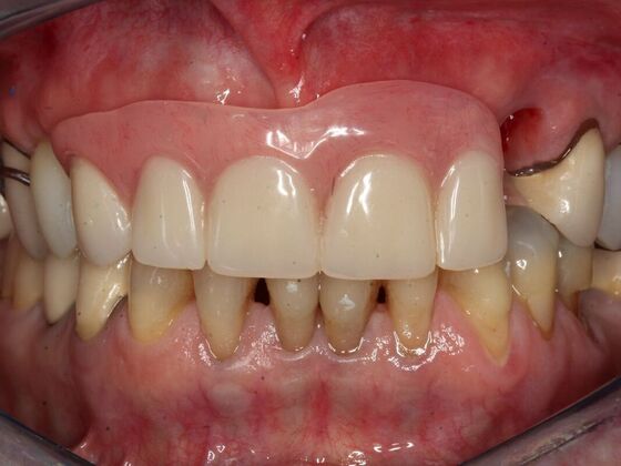 Implant Retained Overdentures Janis - Before