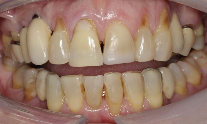 Implant Restorations Susan - Before