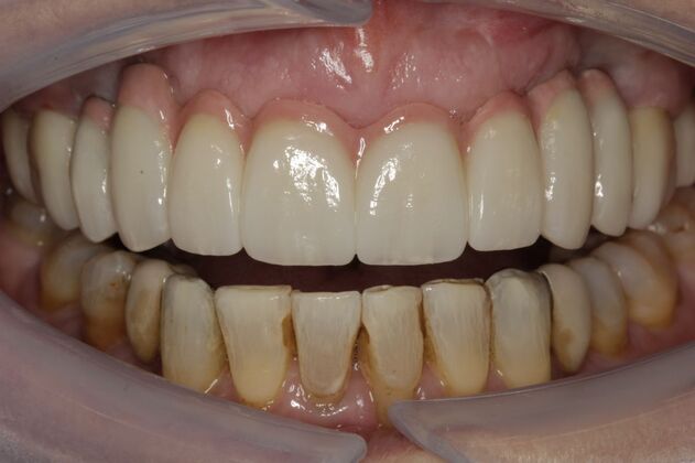 Implant Restorations Susan - After