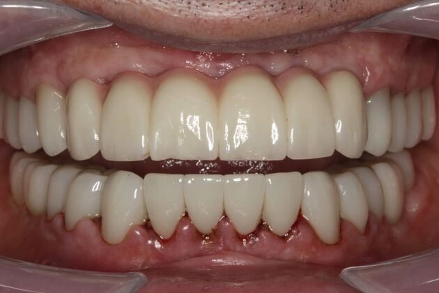 Full Mouth Rehabilitation Paul - After